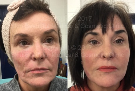 PDO thread lift before & after by Helen Bowes