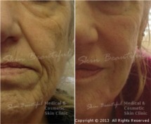 Non surgical facelift by Helen Bowes