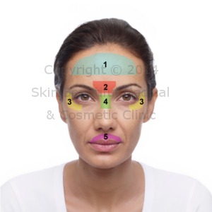 Facial areas treated with BOTOX®