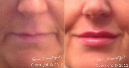 Lips by Helen Bowes before and after treatment