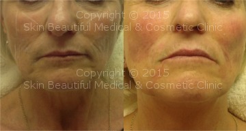 Signature 6 point non surgical facelift by Helen Bowes
