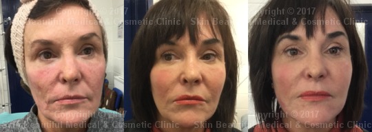 thread lift before and after 7 point by Helen Bowes