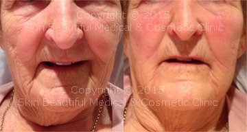SIgnature 8 point non surgical facelift by Helen Bowes