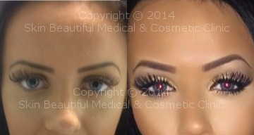 Eyebrow lift (Riah Reed) Before & After