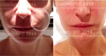 Corrective dermal fill (from overfilling)er treatment