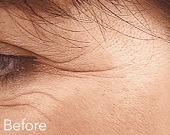 Crows feet lines treatments