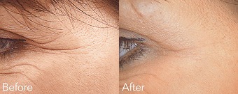 Crows Feet Before & After Treatment