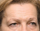Forehead lines (wrinkles) treatments