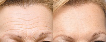 Forehead Lines Before & After Treatment