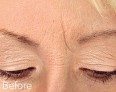 Glabellar (frown) lines treatments