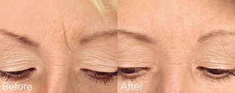 Glabellar Lines before & After Treatment