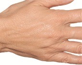 Skin rejuvenation with dermal fillers