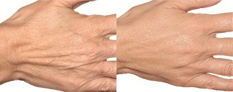 Skin rejuvenation for hands with dermal fillers