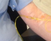 IV Vitamin injection therapy