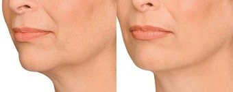 Jaw Definition Before & After Treatment