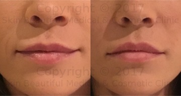 Lip Fillers philtrum definition by Helen Bowes