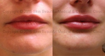Lip augmentation & Correction