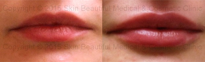Lip augmentation and correction by expert Helen Bowes