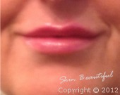 Lip enhancement treatments