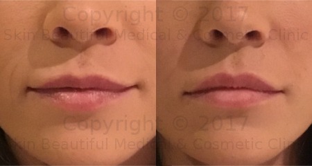 lip filler by Helen Bowes Cupids Bow definition with Juvederm