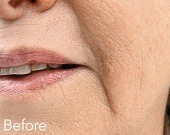 Marionette (mouth) lines treatments