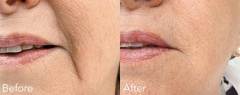 Marionette (Mouth) Lines Before & After Treatment
