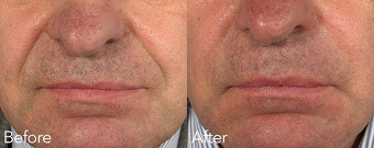 Nasolabial Folds (Nose To Mouth Lines) Before & After Treatment