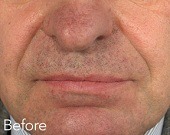 Nasolabial folds (nose to mouth lines) treatments
