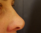 Non surgical nose reshaping