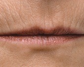 Lip (perioral) lines