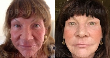 5 Point PDO Thread lift & skin rejuvenation by Helen Bowes