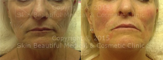 6 point signature facelift by HELEN BOWES