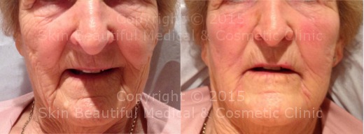 8 point Signature Facelift by HELEN BOWES