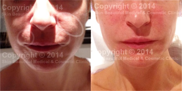 Corrective dermal filler procedure from overfilling by another clinic