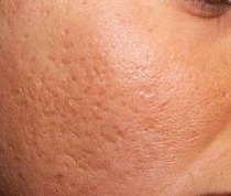 Acne scarring (box car, icepick, rolling) & chicken pox scars
