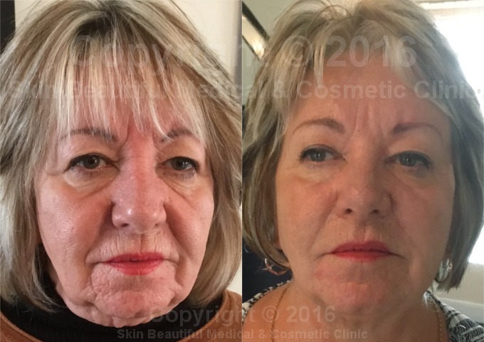 7 Point PDO Thread Facelift Exeter Milton Keynes Bristol Coventry Swansea Bournemouth by Helen Bowes