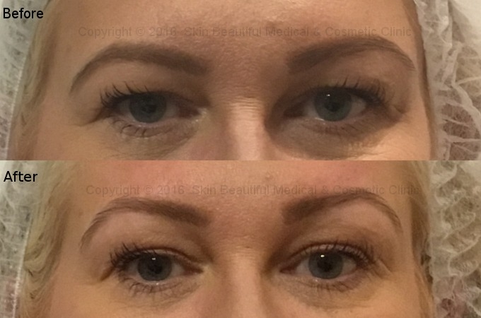 PDO thread brow lift Exeter Milton Keynes Bristol Coventry Bournemouth Swansea by helen Bowes
