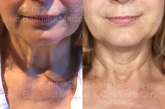 PDO thread lift neck before & after by Helen Bowes