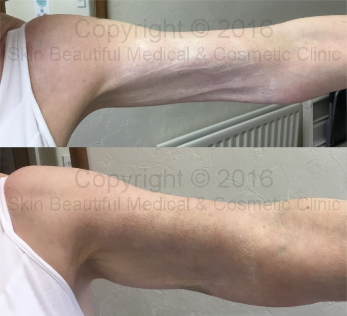 PDO thread lift skin tightening for arms by Helen Bowes
