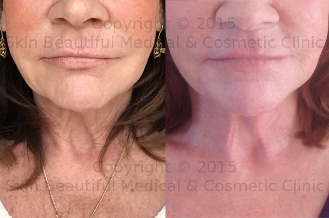 PDO thread neck lift Exeter Milton Keynes Bristol Coventry Bournemouth Swansea by Helen Bowes