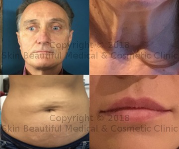 PDO thread lift dermal fillers cosmetic treatments at Skin Beautiful Clinics