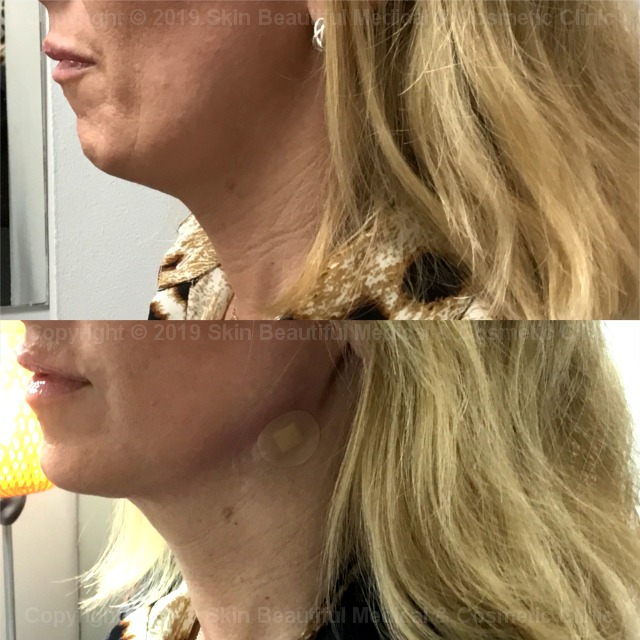 PDO thread Jowl lift jaw tightening chin enhancement UK by Helen Bowes