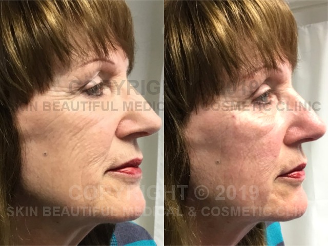 Profhilo mid face cheek filler by Helen Bowes